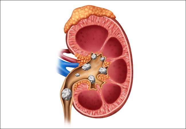 kidney stone