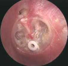 Fluid in the ear