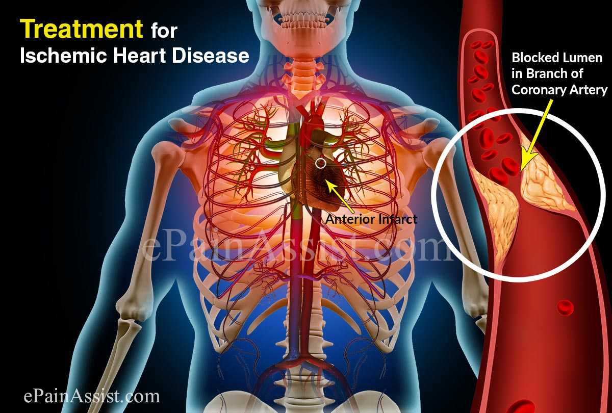 Ischemic Heart Disease