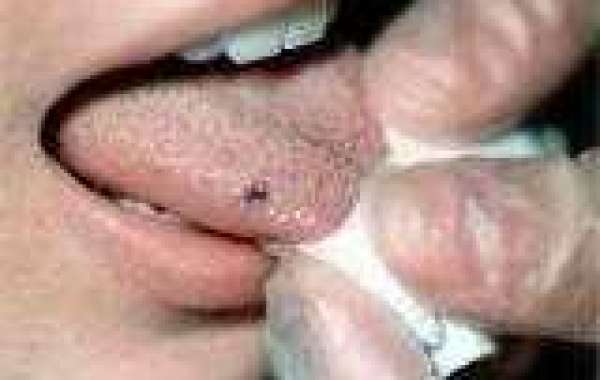 Black Spots on Tongue လျှာအမဲစက်
