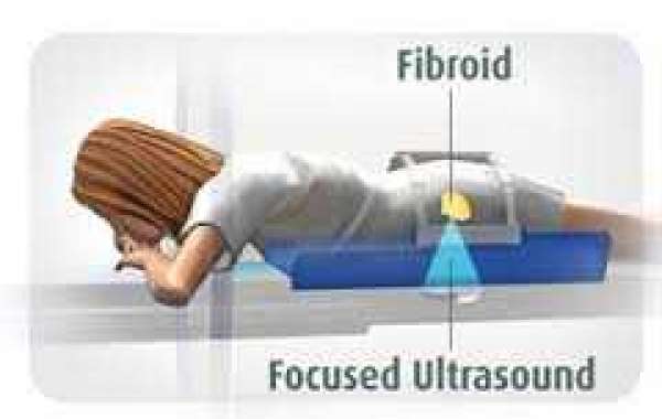 Focused ultrasound surgery for uterine fibroids သားအိမ်အလုံးကို အာလ်ထွာဆောင်းနည်းနဲ့ကုသခြင်း