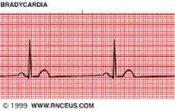 Triglyceride and Sinus bradycardia နှလုံးခုန် နှေးလွန်းတာ မကောင်းပါ