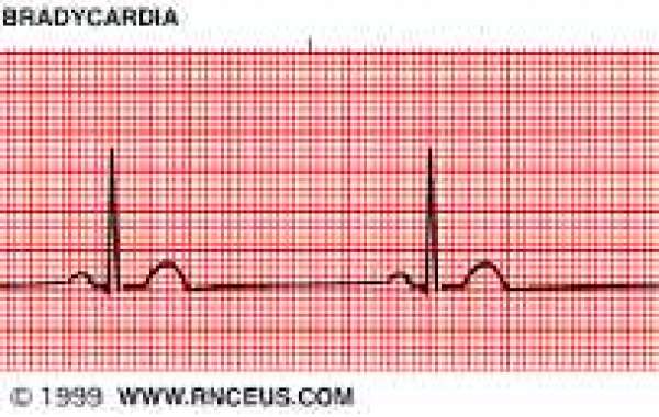 Triglyceride and Sinus bradycardia နှလုံးခုန် နှေးလွန်းတာ မကောင်းပါ