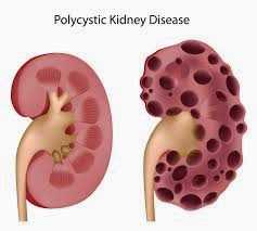 Polycystic Kidney Disease