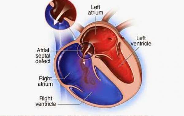 ASD (2) နှလုံးအပေါက် (၂)