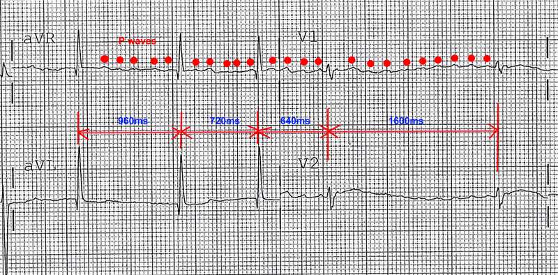 Supraventricular Tachycardia