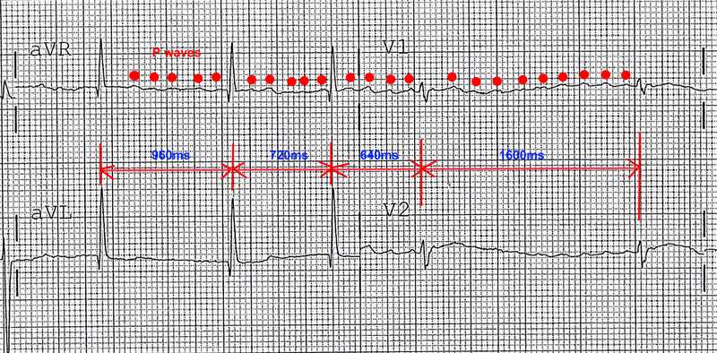 Supraventricular Tachycardia