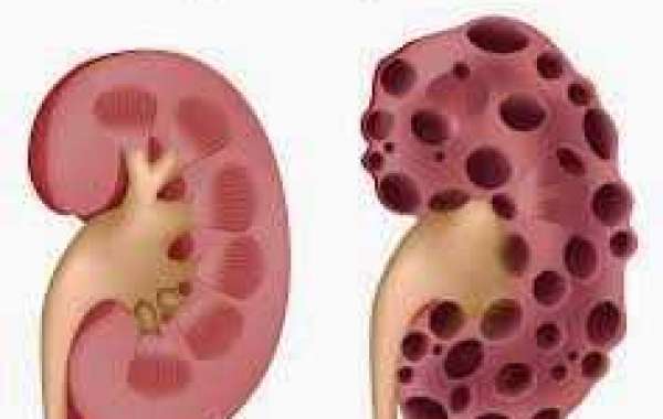Polycystic Kidney Disease ကျောက်ကပ်ရောဂါ