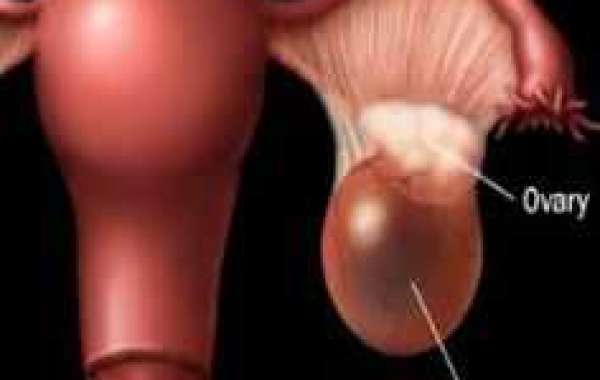 Ovarian masses မျိုးဥအိမ် အစိုင်အခဲများ