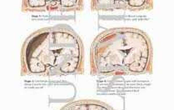 Subdural effusion ဦးနှောက်-အလွှာအောက်မှာ အရည်လာအောင်းနေခြင်း