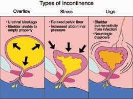 Urine Dribbling