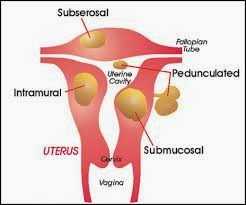 Submucous fibroids