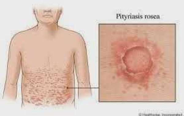 Pityriasis rosea အရေပြားနာတမျိုး