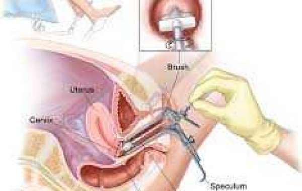 ASCUS Pap abnormality သားအိမ်ဝစစ်ချက် ပုံမှန်မထွက်