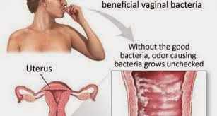 Bacterial vaginosis