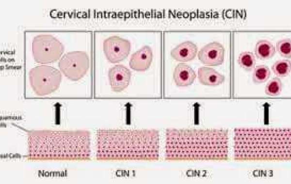 Cervical intraepithelial neoplasia (CIN) သားအိမ်ဝ ရောဂါတမျိုး