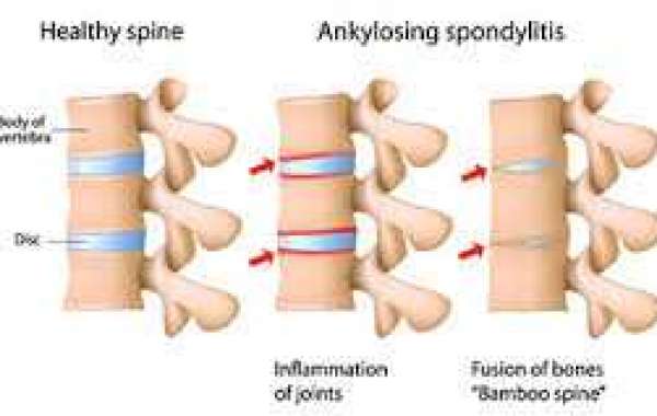 Ankylosis အဆစ်ရောဂါ