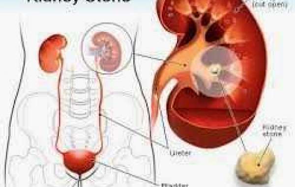 Kidney stones ကျောက်ကပ်-ကျောက်