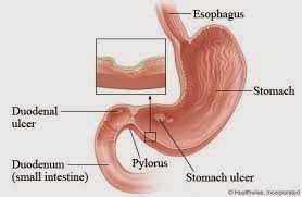 Peptic Ulcer Diagnosis