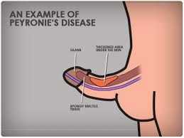 Peyronie's Disease