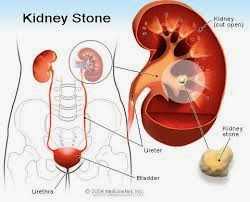 Kidney stones