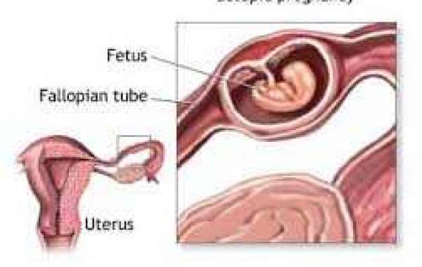 Ectopic Pregnancy in exile ပြည်ပမှာ သားအိမ်ပြင်ပသန္ဓေတည်ခြင်း