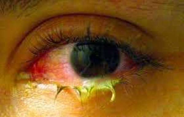 Infective conjunctivitis မျက်စိကျိန်းခြင်း
