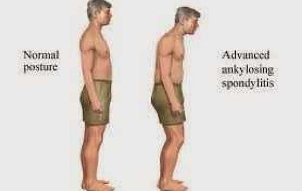 Ankylosing spondylitis အင်ကိုင်လိုဇင်း စပွန်ဒိုင်လိုက်တစ်