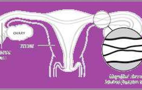 Infertility and Fallopian Tube Procedures သားအိမ်ပြွန်ကျဉ်းလို့ ကိုယ်ဝန်မရနိုင်သေးခြင်း