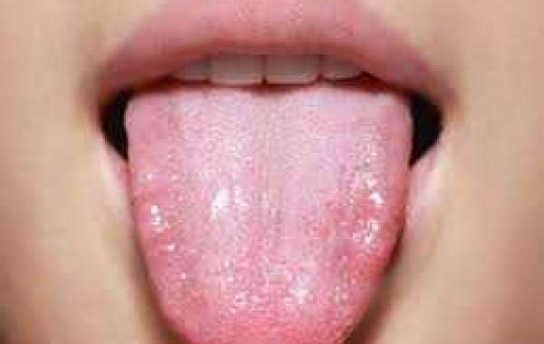 Tongue cancer လျှာကင်ဆာ