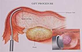 Infertility and Fallopian Tube Procedures 