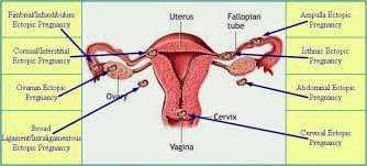 Pregnancy outside the Uterus
