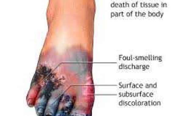 Gangrene (ဂင်ဂရင်း) အသားသေသွားခြင်း