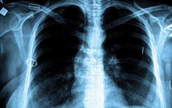TB joins HIV as most deadly infection
