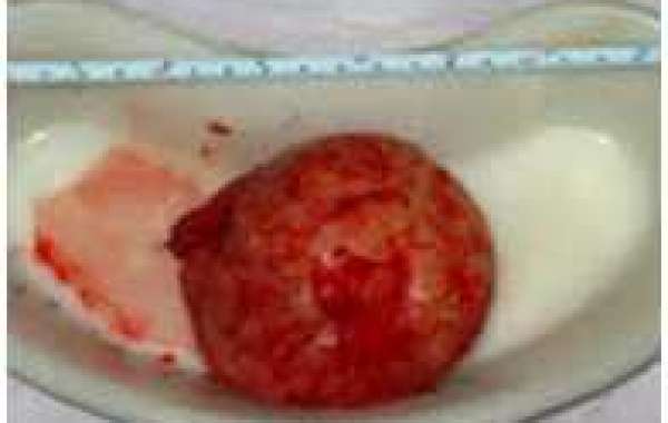 Uterine Fibroid (2) သားအိမ်အလုံး (၂)