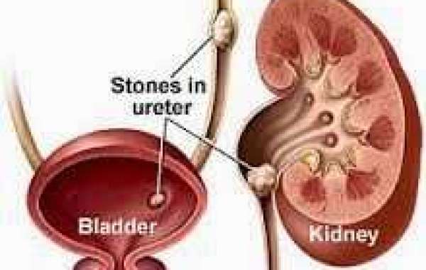 Kidney stones ကျောက်ကပ်-ကျောက်