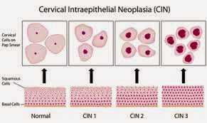 Cervical intraepithelial neoplasia (CIN)