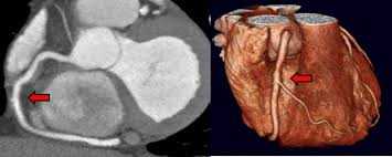 CT coronary angiogram