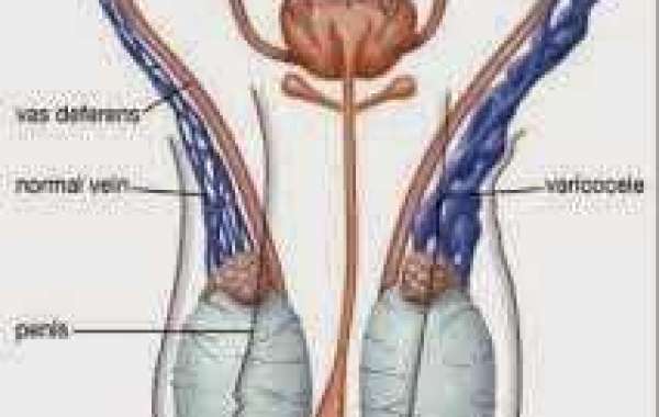 Varicocele (ဗေရီကိုဆီးလ်)