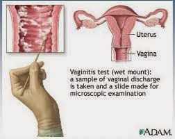 Vulvovaginitis