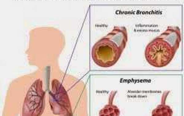 COPD နာတာရှည် အသက်ရှူလမ်းပိတ်ရောဂါ