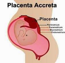 Placenta accreta