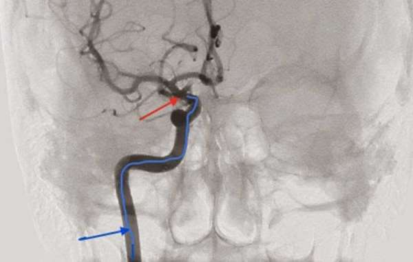 Stem cells can be safely infused in brain to promote stroke recovery