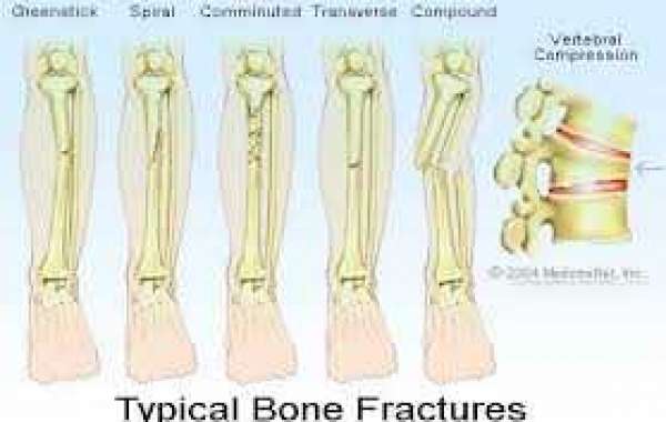 Fracture အရိုးကျိုးခြင်း