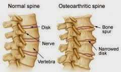 Osteophytosis