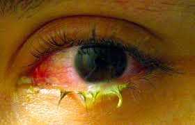 Infective conjunctivitis