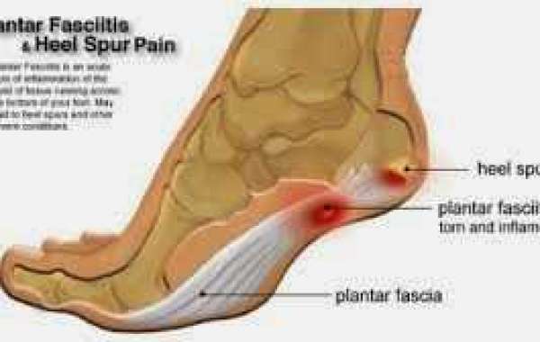 Plantar fasciitis ခြေဖနောင့်နာရောဂါ