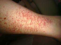 Petechiae