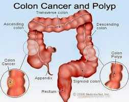 Colorectal cancer