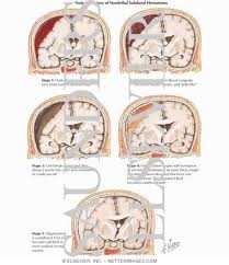 Subdural effusion